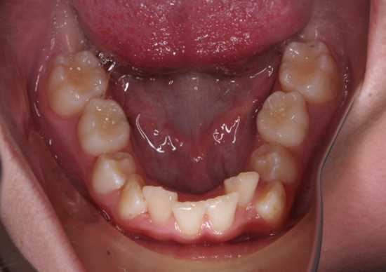 affollamento dentario