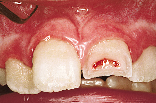 frattura dentale complicata