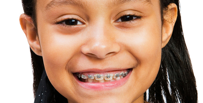 apparecchio denti bambini