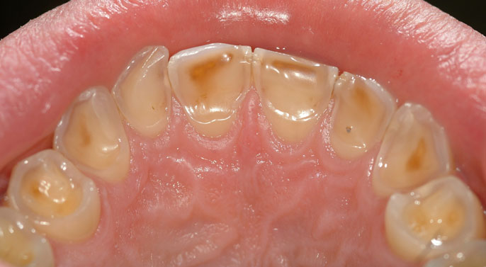 erosione dentale