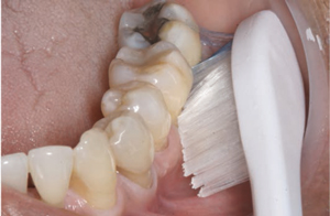 abrasione dentale