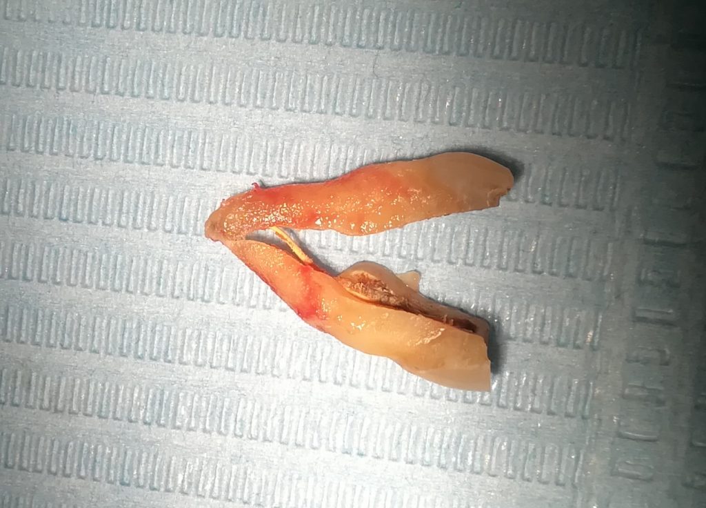 Estrazione dentaria ecco quando e come farsi togliere un dente