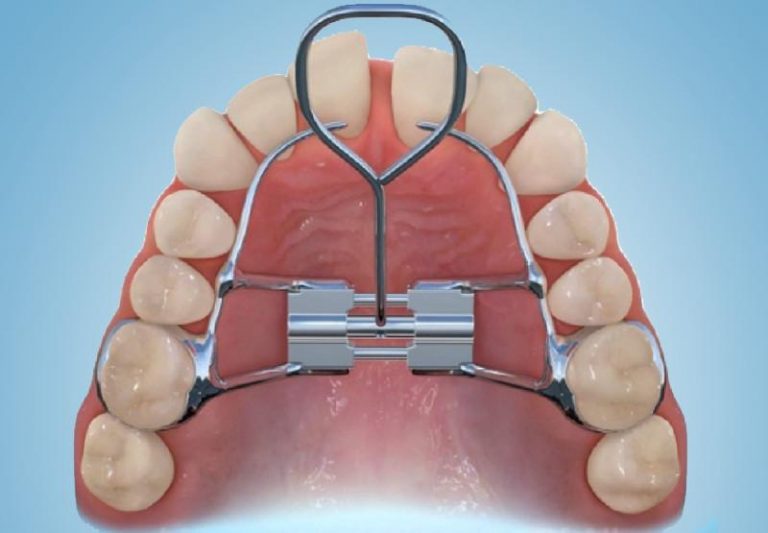 Espansore rapido del palato: guida all'uso e istruzioni per i genitori