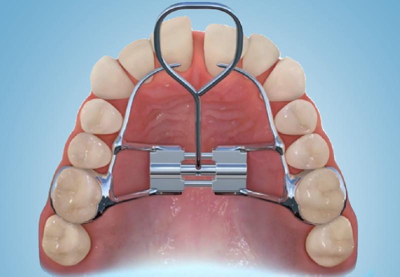 Viti Di Espansione Ortodontica Rapida Per Espansore Palatale - 13 Mm (Ricambio)
