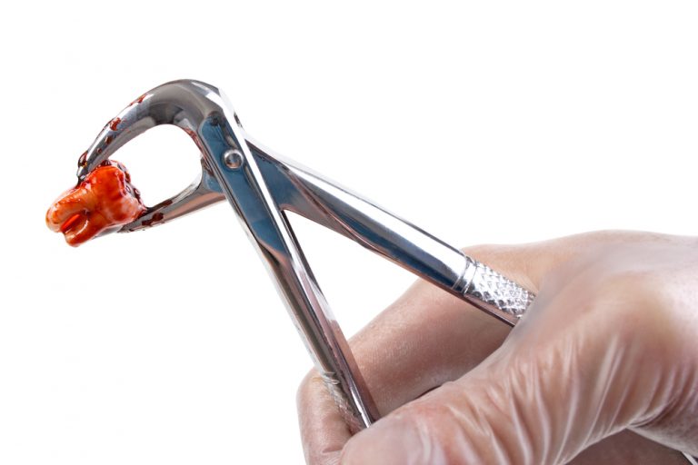Estrazione dentaria ecco quando e come farsi togliere un dente Estrazione dentaria ecco quando e come farsi togliere un dente