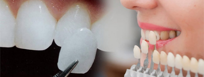 mettere le faccette dentali