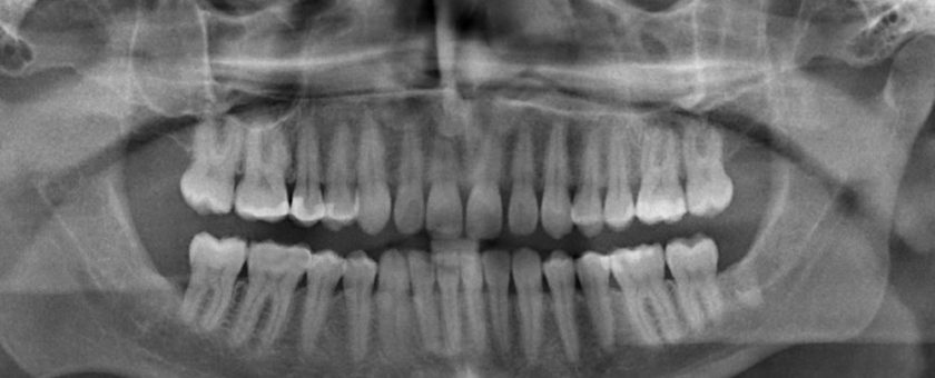 radiografia panoramica