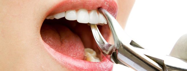 estrazione dentale