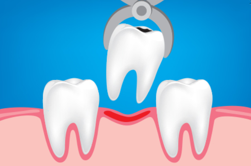 estrazione di un dente