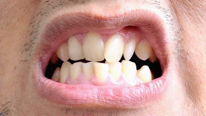 malocclusioni dentarie
