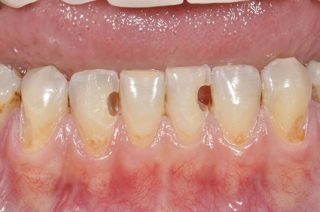 Otturazione dentale tutto quello che c'è da sapere prima dell'intervento