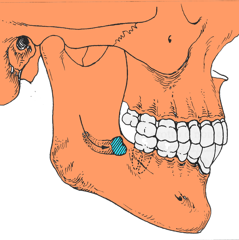 curva di raddrizzamento terzo molare