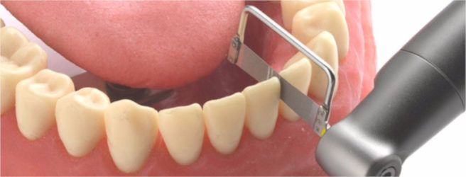 limatura dei denti
