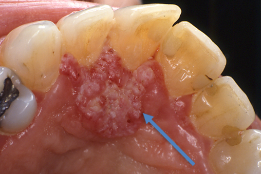 carcinoma orale