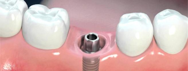 impianti dentali con poco osso